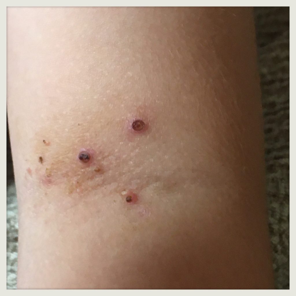 木酢液を使用した水いぼ治りかけ画像