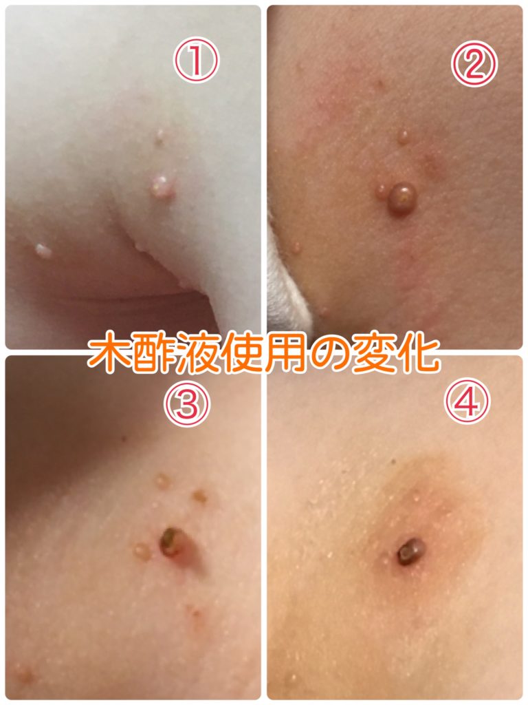 木酢液を使用した水いぼ治療経過画像