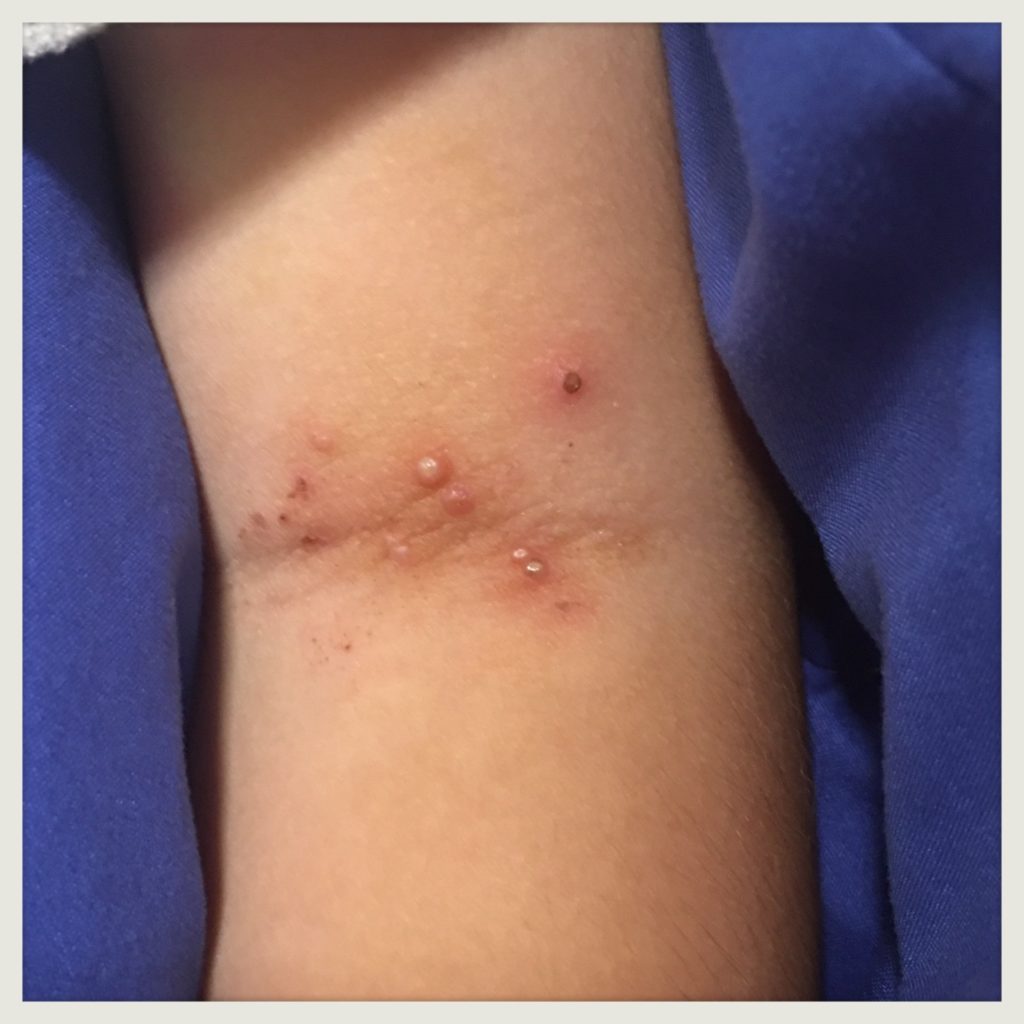 木酢液を使用した水いぼ画像