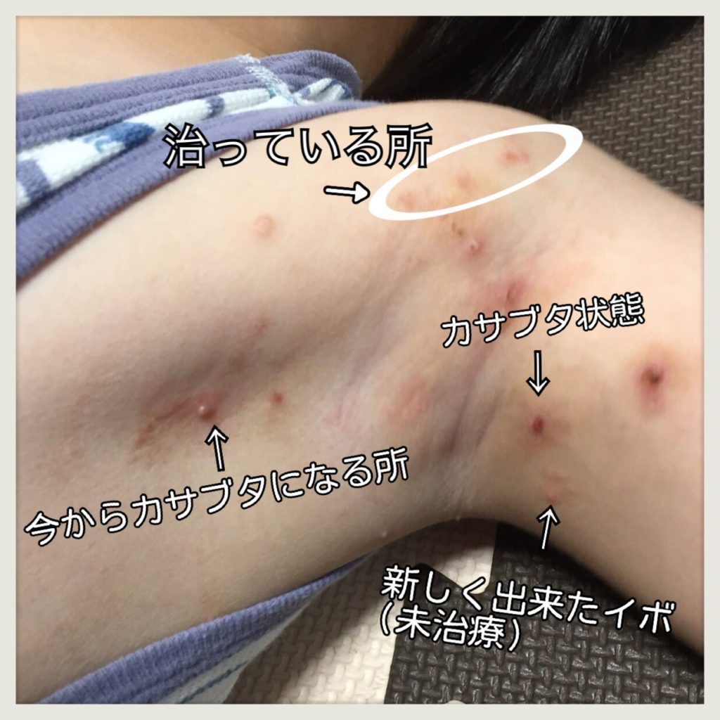 木酢液を使用した水いぼ治療経過画像