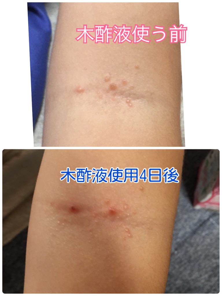 木酢液を使用した水いぼ画像