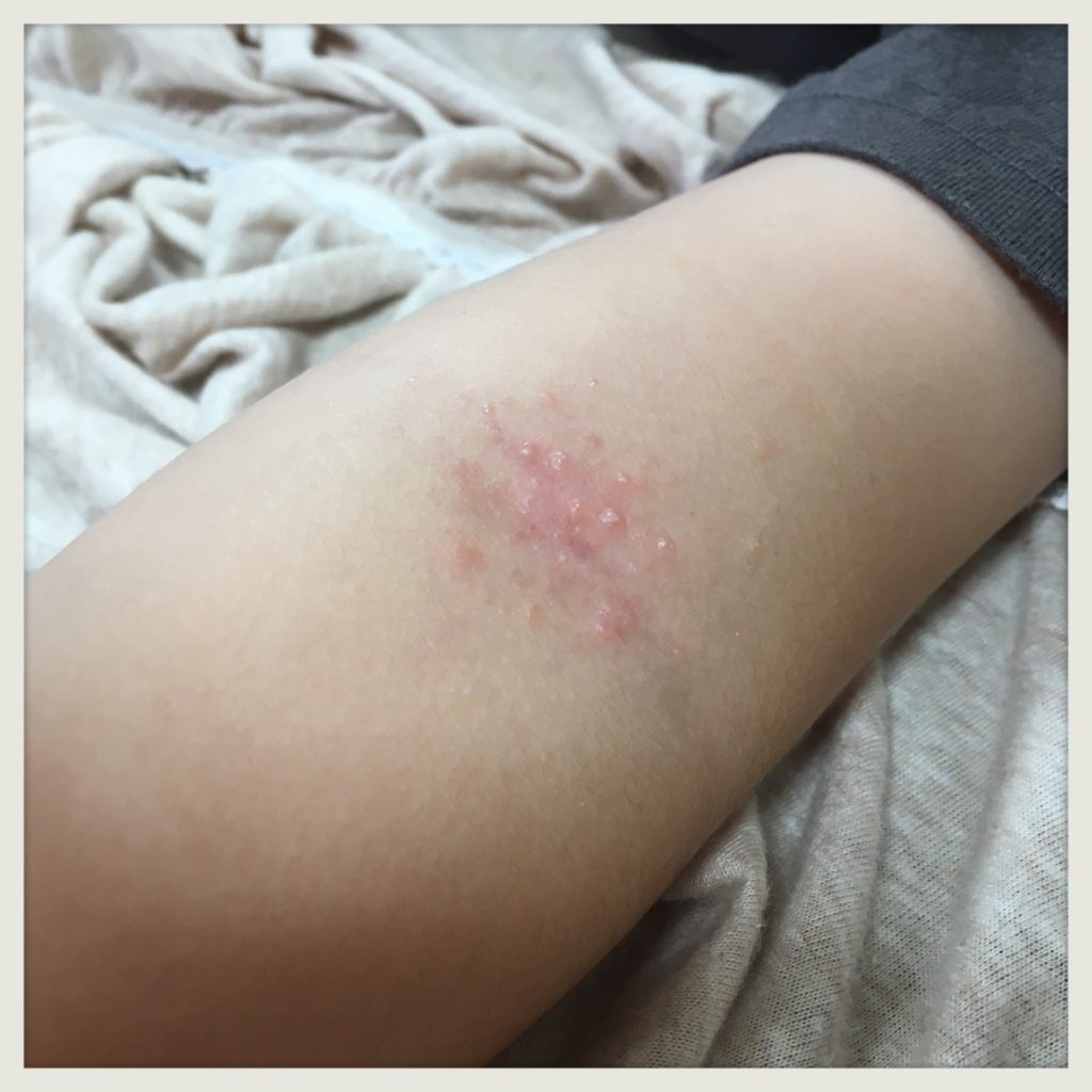 腕に出来た水いぼ画像