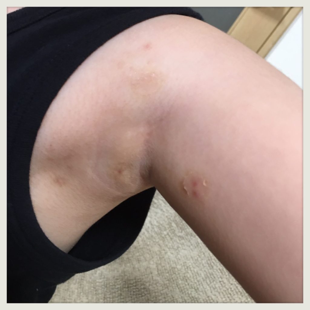 木酢液を使用した水いぼ治療経過画像