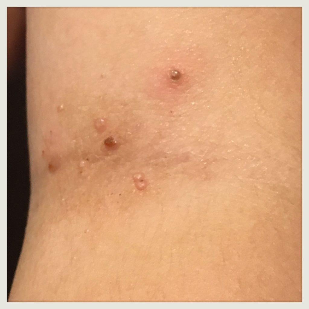 木酢液を使用した水いぼ画像